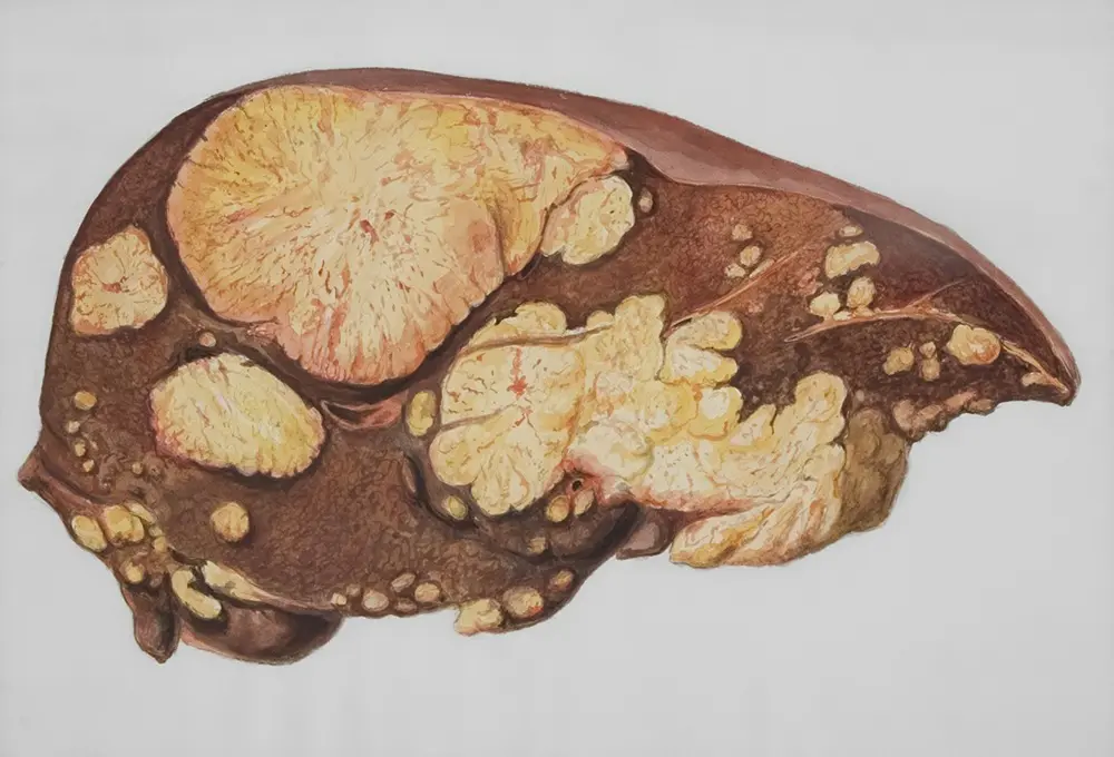 Roaccutane, Liver Function Tests and Alcohol