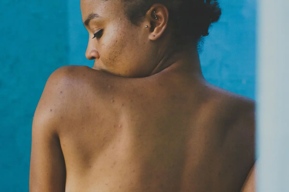 How to remove back acne quickly: realistic timelines and fast-track tips