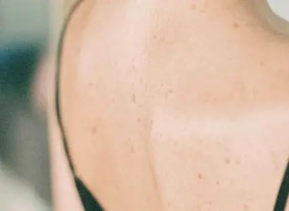 Back Acne: Why It Happens and What Clears It - botonics