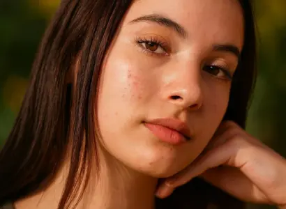 How to Get Rid of Acne Scarring
