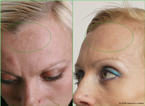 Kaja_Large_Before_After_Forehead_Botox_Dermal_fillers_Lip_enhancement_Skin_peel_g