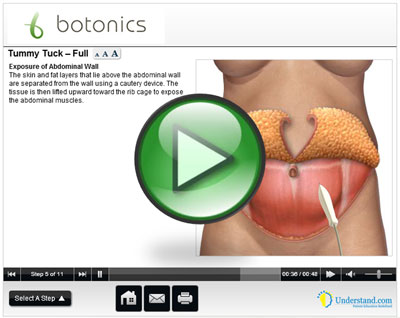 botonics 3D Animation of Mini Tummy tuck | Abdominoplasty Procedure