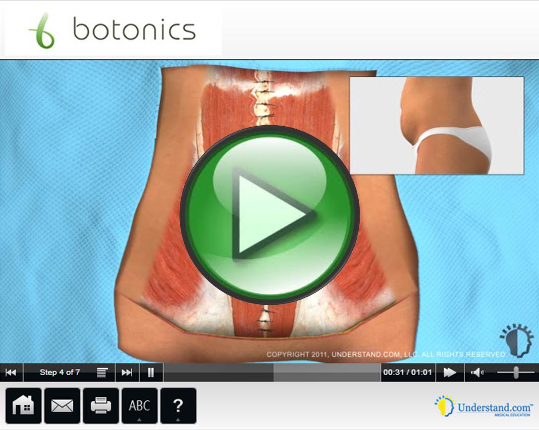 botonics 3D Animation of Full Tummy Tuck Abdominoplasty Procedure