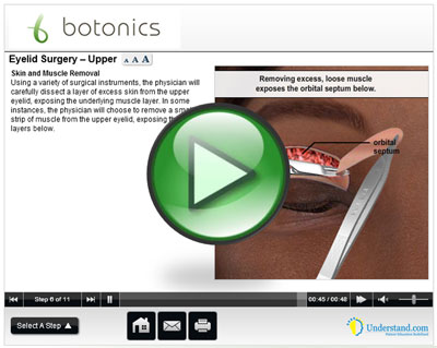 botonics 3D Animation of Eye Lid | Upper Blepharoplasty Procedure