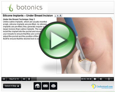 botonics 3D Animation of Silicone Breast Augmenation Procedure