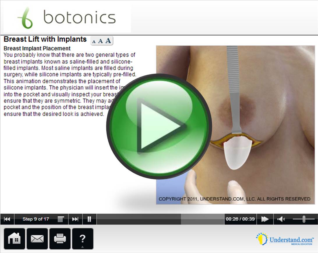 botonics 3D Animation of Breast Lift with Implants Procedure