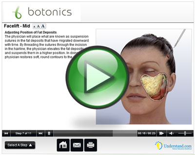 botonics 3D Animation of Face Lift Procedure