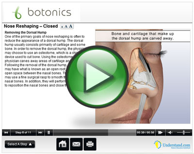 botonics 3D Animation of Nose Job Surgery | Rhinoplasty Procedure