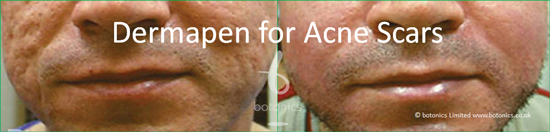 acne_scars_treatment_dermapen_collagen_induction_therapy_medical_needling_treatment_before_and_after_botonics_3_550_wide