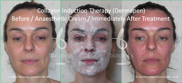 Дермапен отзывы до и после Sale after dermapen treatment care in stock