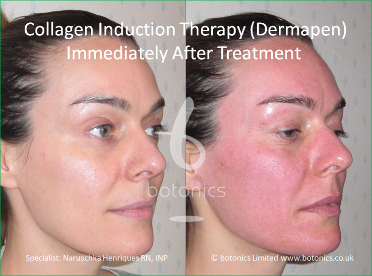 before dermaroller dermapen treatment redness immediately collagen therapy right induction needling treatments immediate comparison