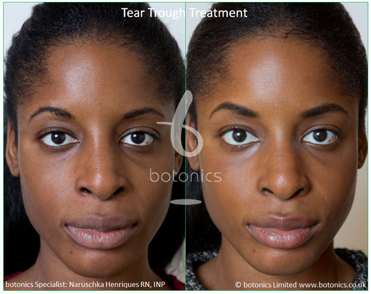 Tear Trough Fillers Before and After Photos Comparison in London, UK