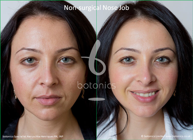 NonSurgical Nose Job Before &amp; After Photos Comparison in
