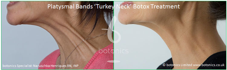 platysmal bands turkey neck botox treatment before and after botonics naruschka henriques 4