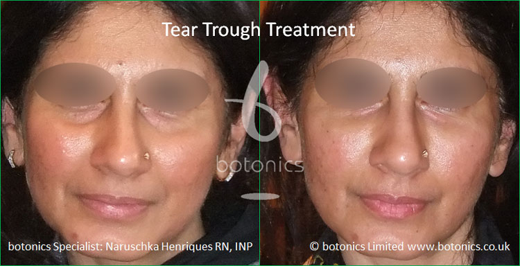 Tear Trough Fillers Before and After Photos Comparison in London, UK