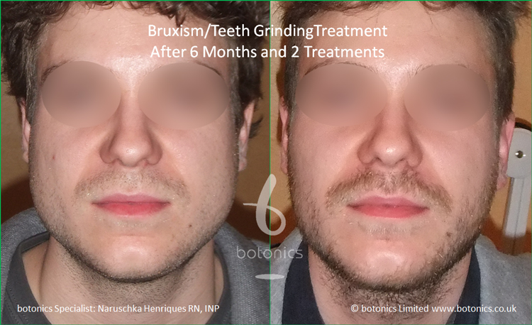 Bruxism Masseter Jaw Reduction With Botox Botonics
