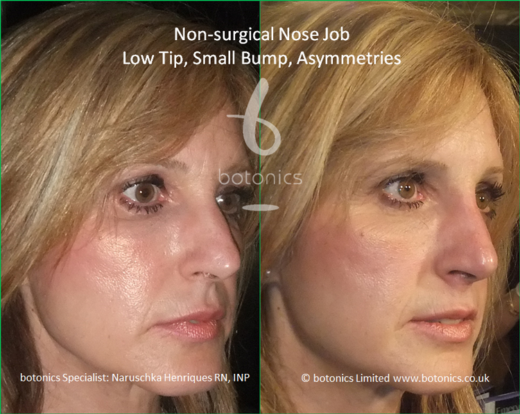 Latin Female Nose Enhancement botonics