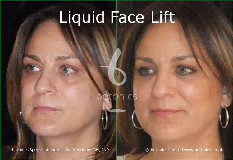 Tear Trough Fillers Before and After Photos Comparison in ...