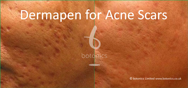 Dermapen Dermaroller Before After Photos Comparison In London Uk