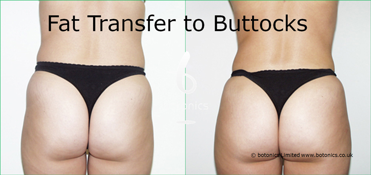 affordable fat transfer to buttocks