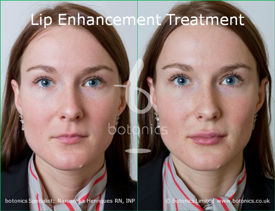 Lip Fillers Enhancement Harley Street London 5 Star Rated