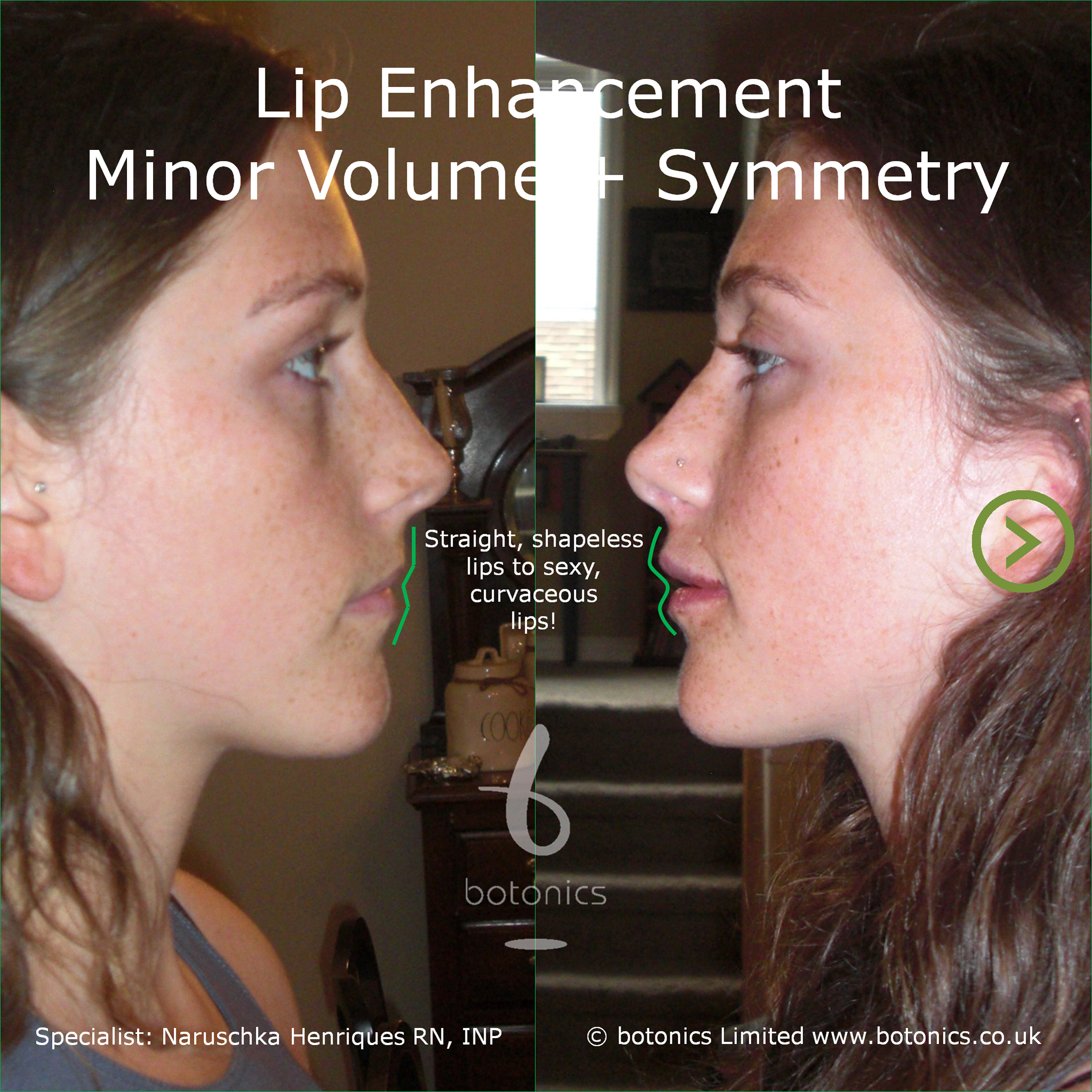 Lip Symmetry & Volume botonics