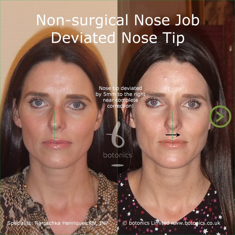 Who has had a non surgical nose job