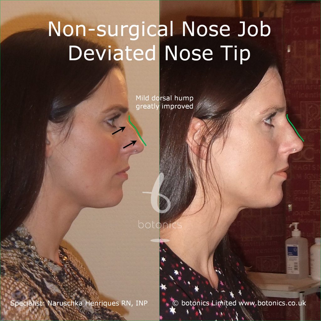 non_surgical_nose_job_devitated_nose_tip_caucasian_female