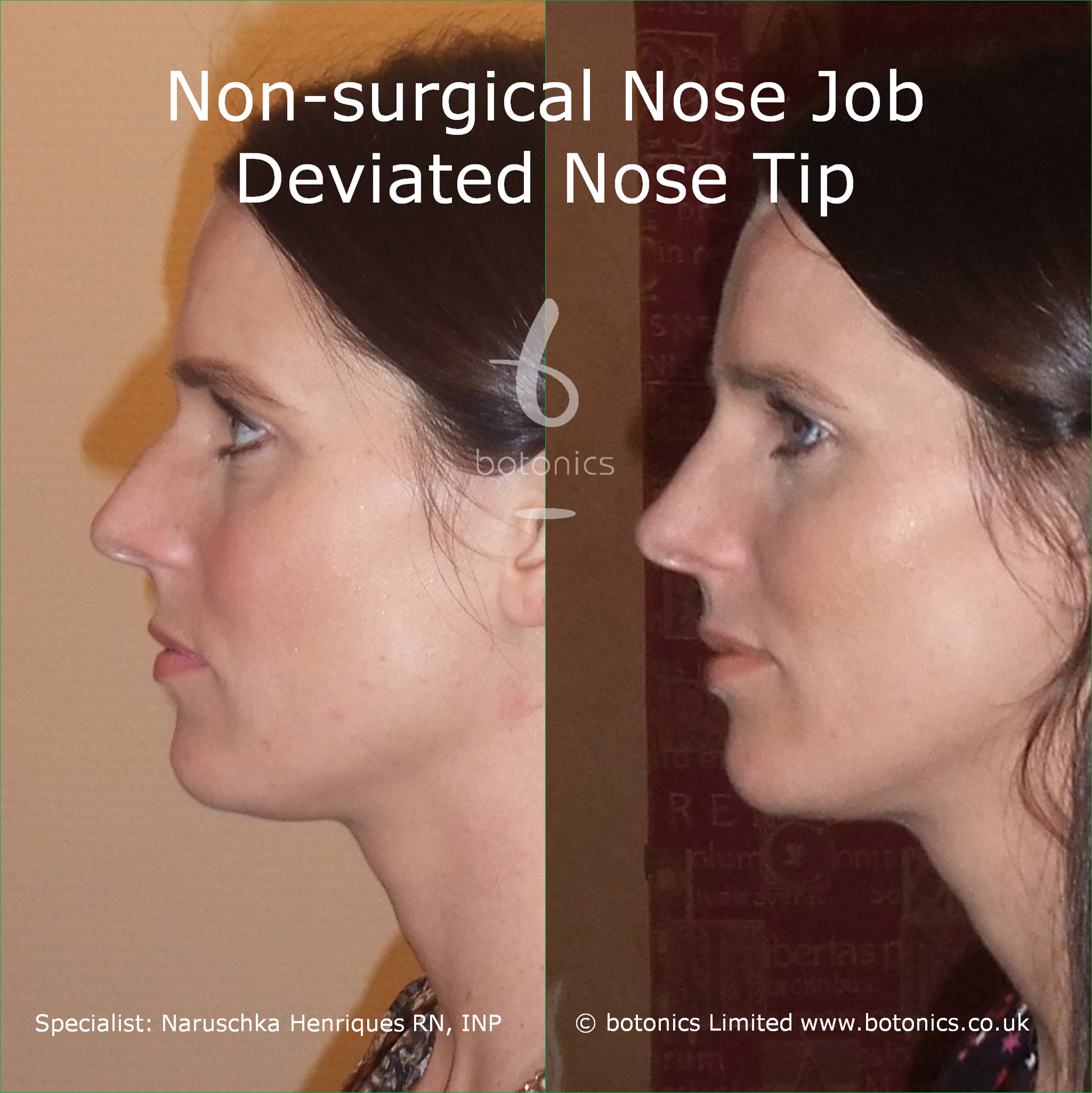 Non-Surgical Nose Job Before & After Photos Comparison in London, UK