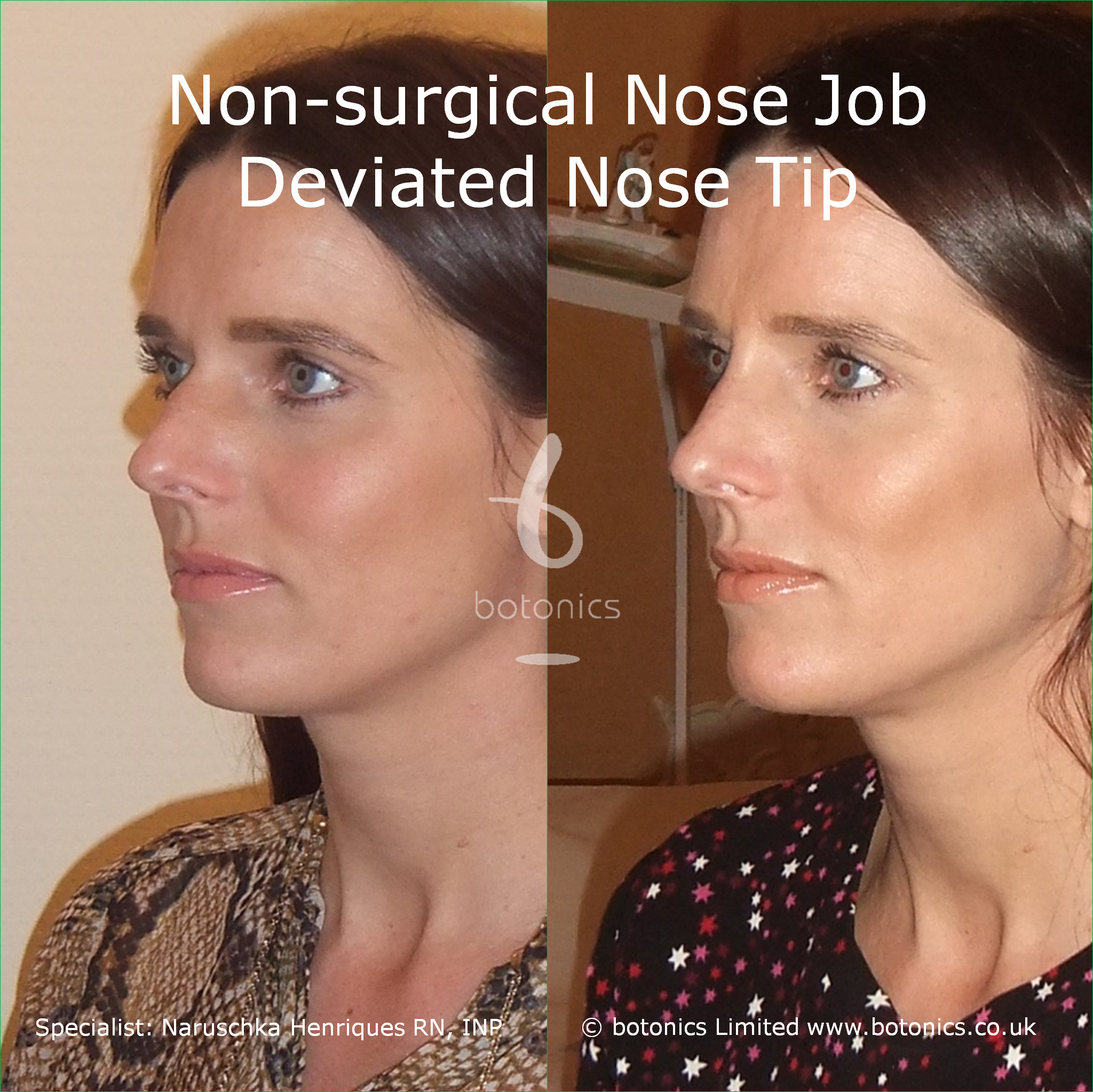 surgical nose job comparison london uk. 