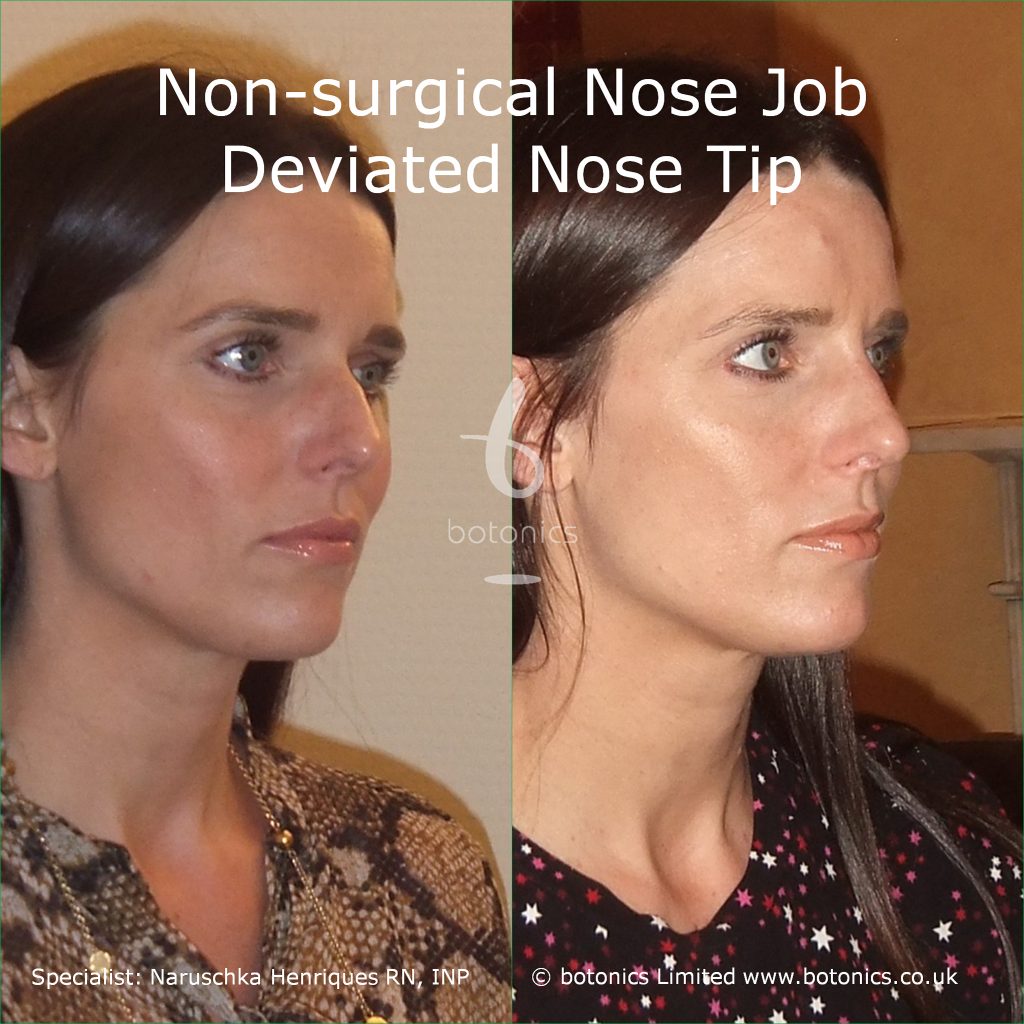 non_surgical_nose_job_devitated_nose_tip_caucasian_female
