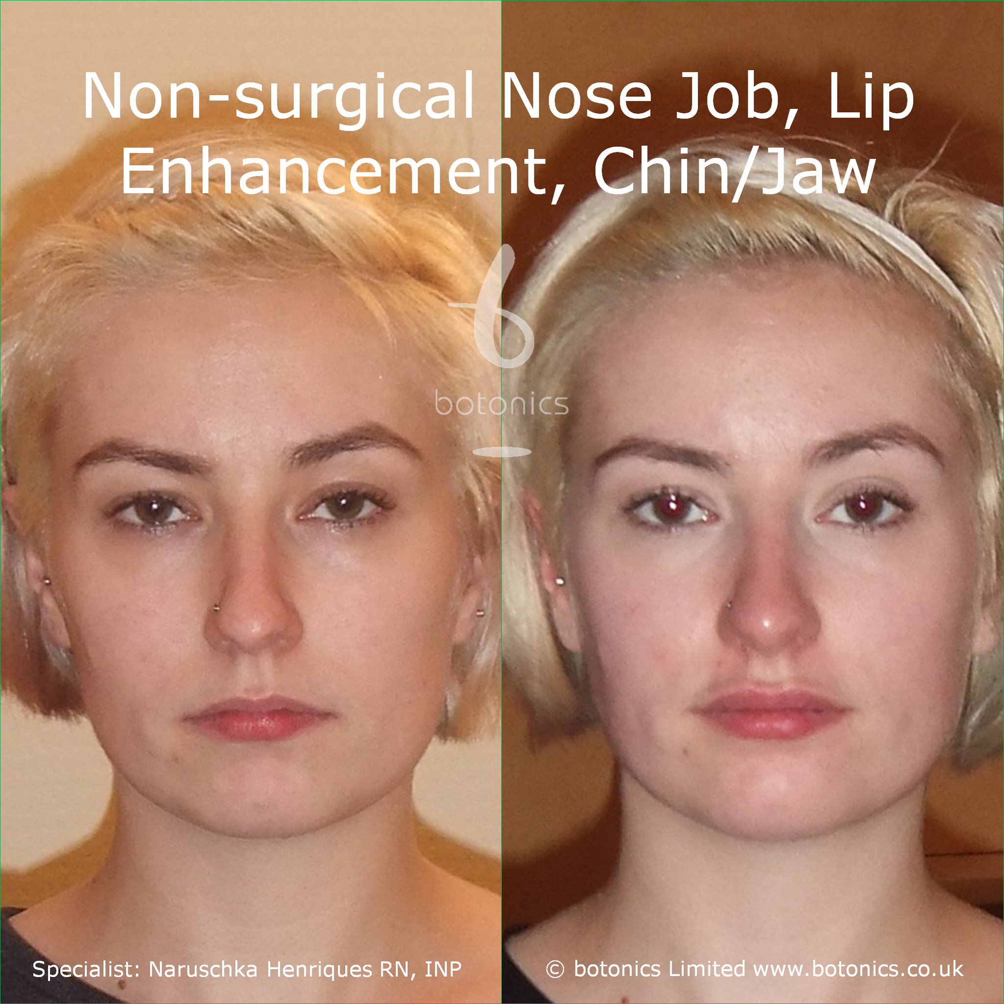 eye enlargement surgery caucasian