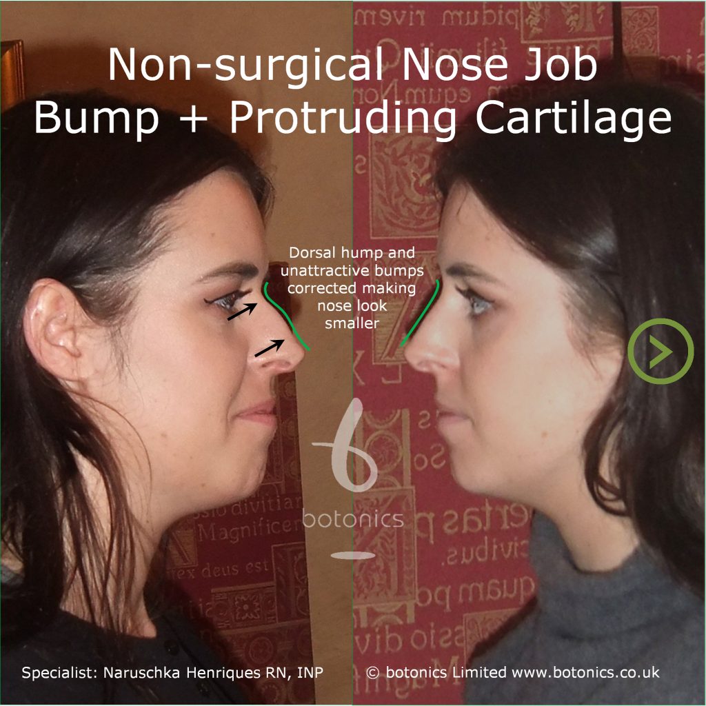 non_surgical_rhinoplasty_bump_protruding_cartilage_pointy_nose_tip