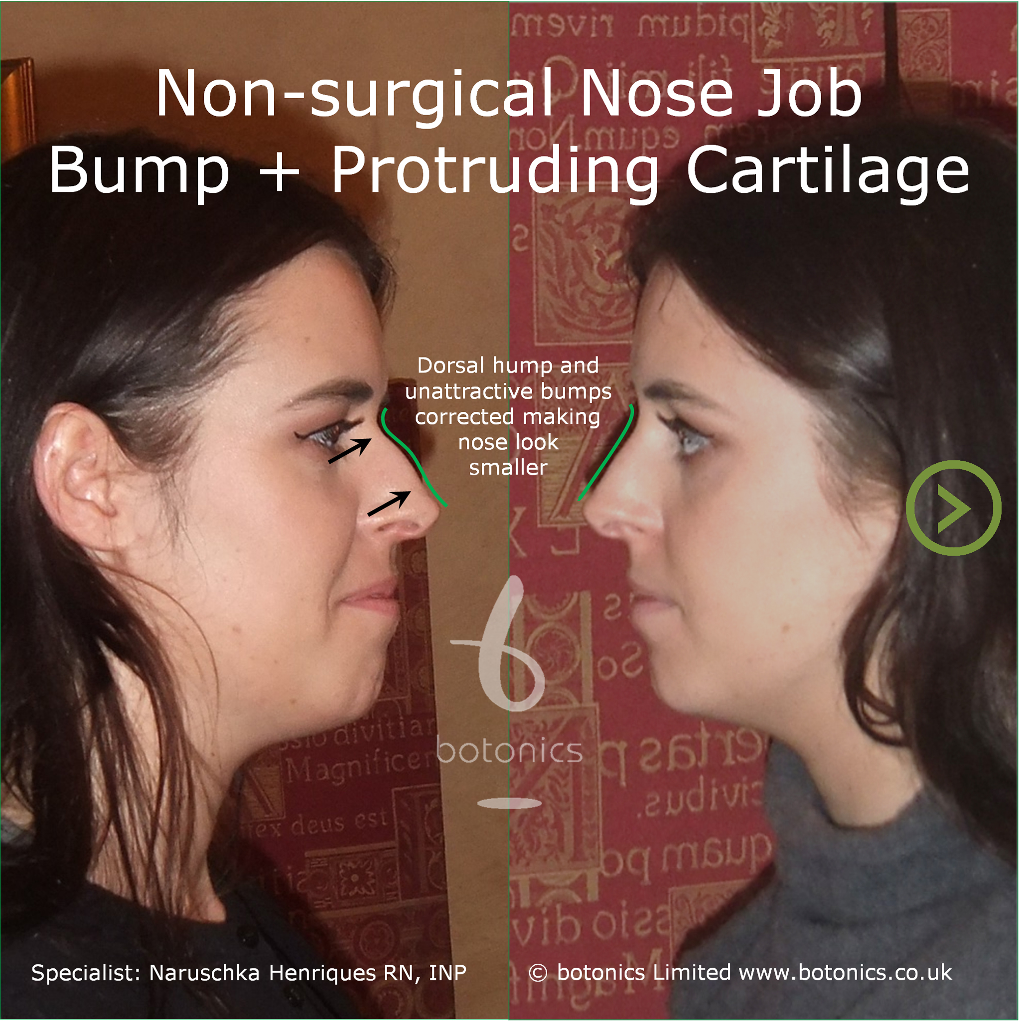 Pointy Nose Tip & Bump botonics