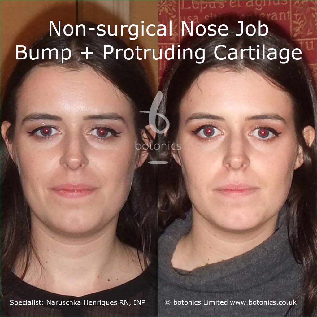 non_surgical_rhinoplasty_bump_protruding_cartilage_pointy_nose_tip_caucasian_female_before_after