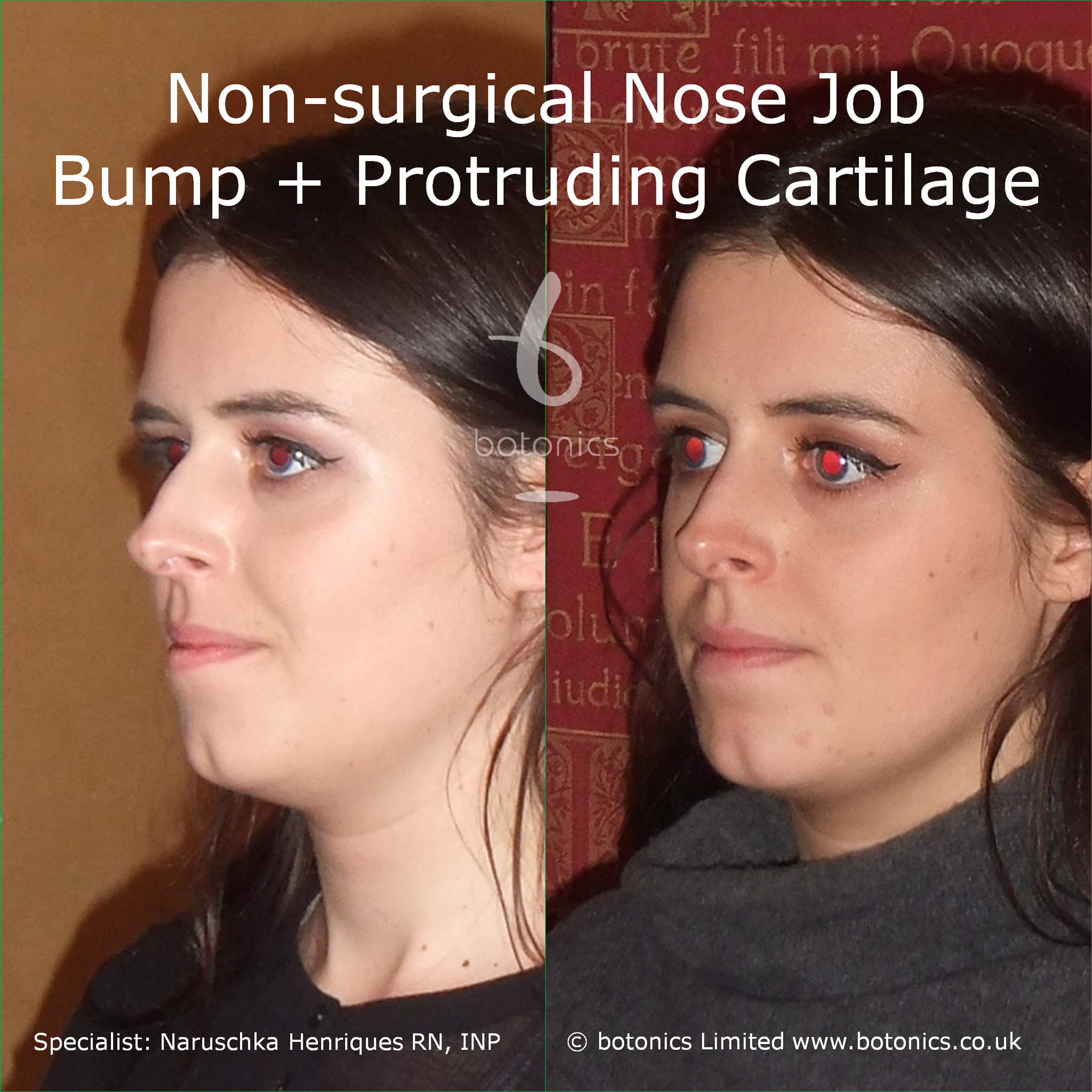 Non Surgical Nose Job Before After Photos Comparison In London Uk
