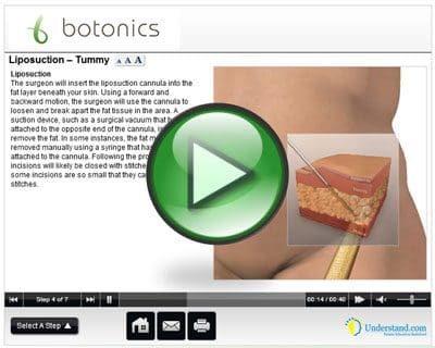 Liposuction Animation