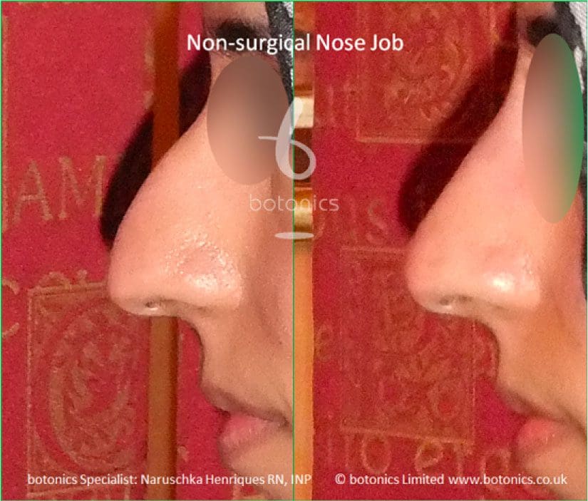 Non-Surgical Nose Job Before & After