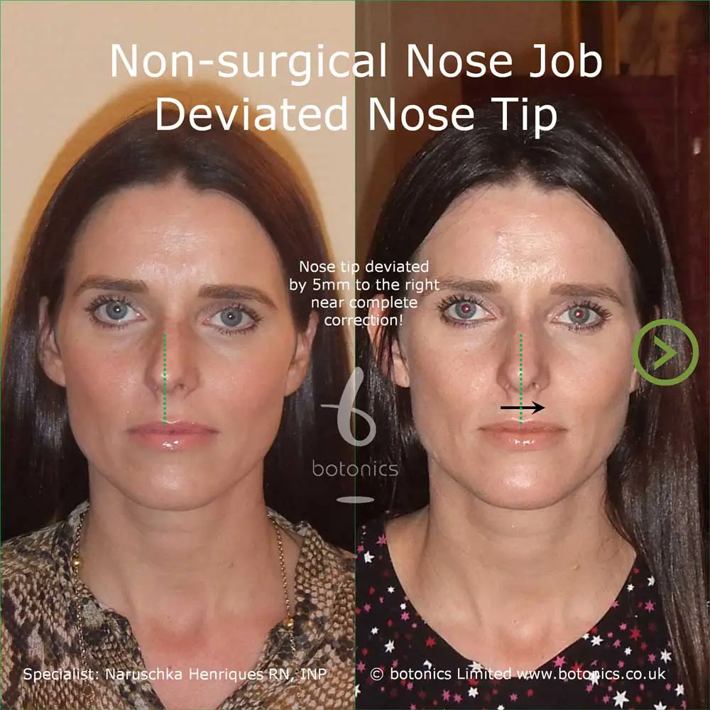 non surgical nose job before and after big nose