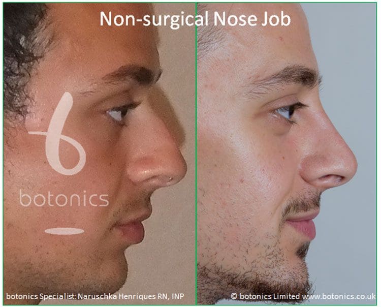 male nose job cost uk