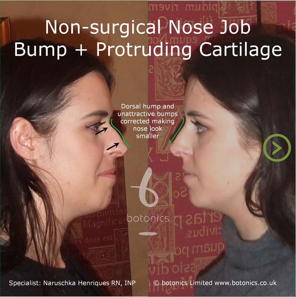 How to Slimmer Nose bridge, Get thinner and sharper nose bridge, Slim down  Nose tip without surgery 