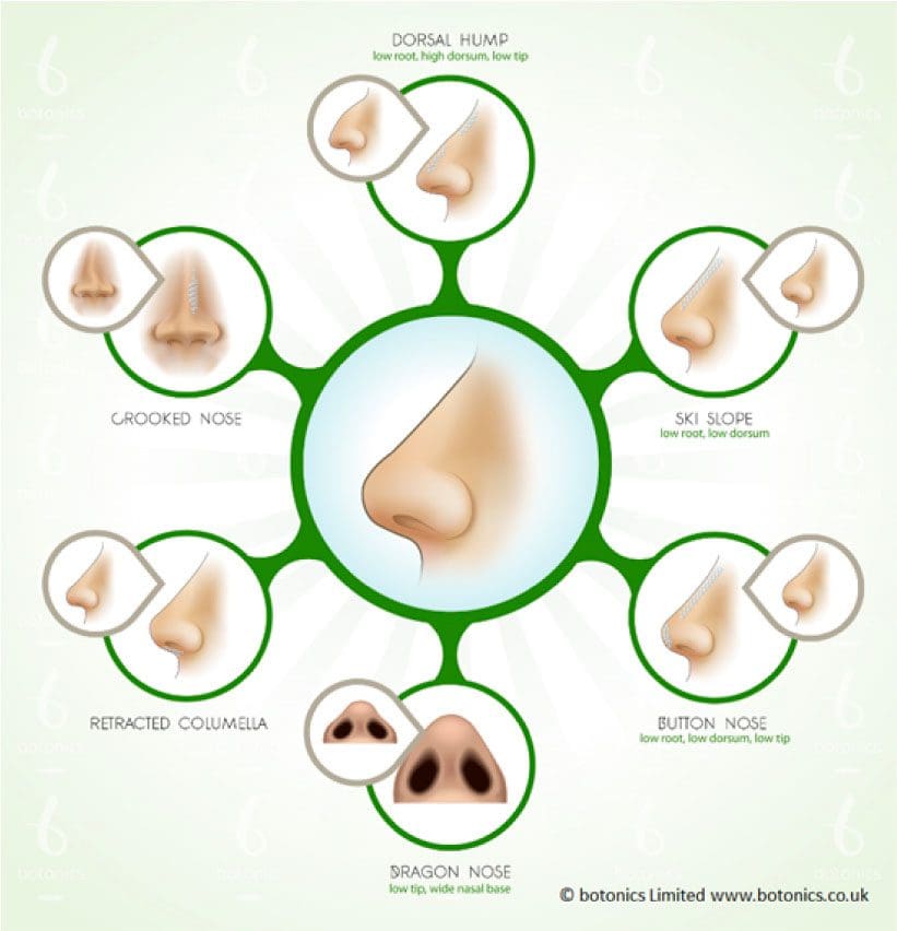 Nose Types That Can be Improved