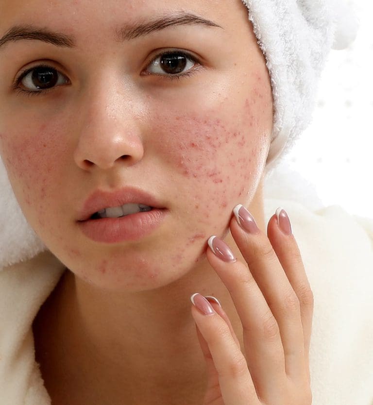 Best Treatment for Acne Scars botonics Harley Street Aesthetics Clinics