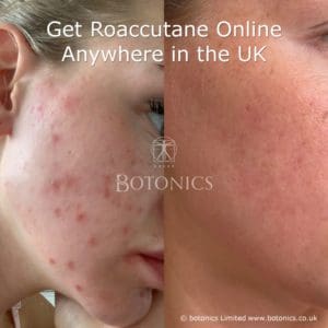Results of roaccutane acne medication treament after six months for young female in the uk