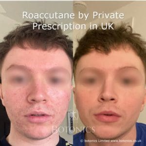 Roaccutane before after photo young male patient