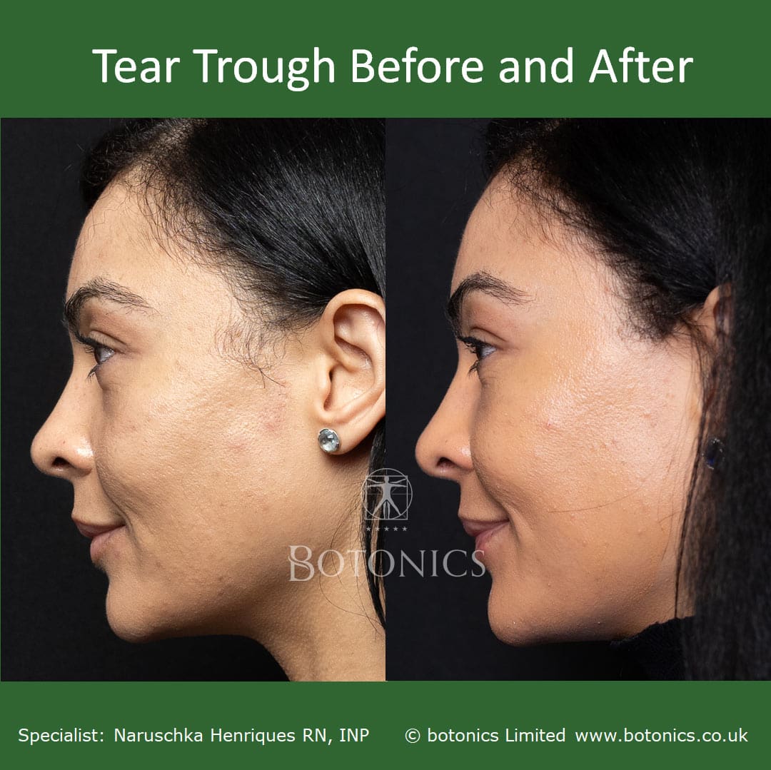 Ema's before and after tear trough treatment, left profile view