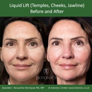 Liquid Lift Before and After Treatment to the Temples, Cheeks and Jawline, face on
