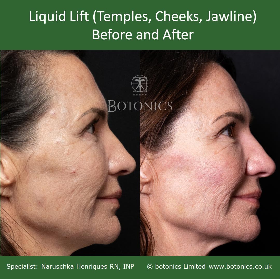 Before and after images from right profile of liquid lift patient
