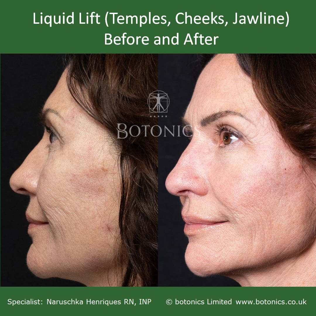 Left profile view of liquid lift patient before temples, cheeks and jawline and after dermal filler treatment