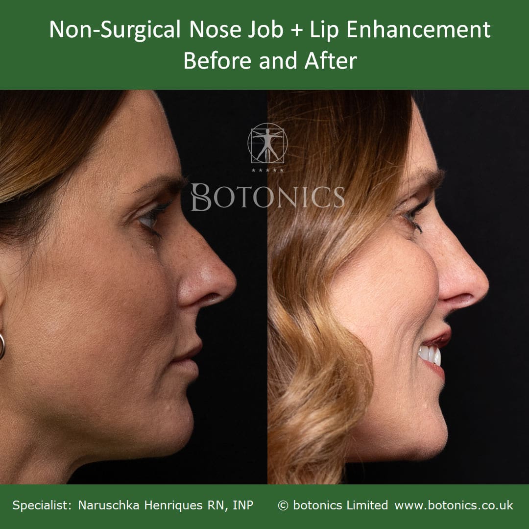 Right profile view of before and after dermal filler treatment for nose dorsal hump and lip enhancement